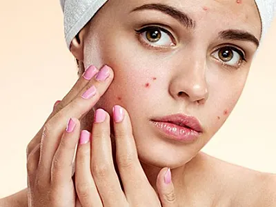 thumbnail image of Acne & Pimple Cure